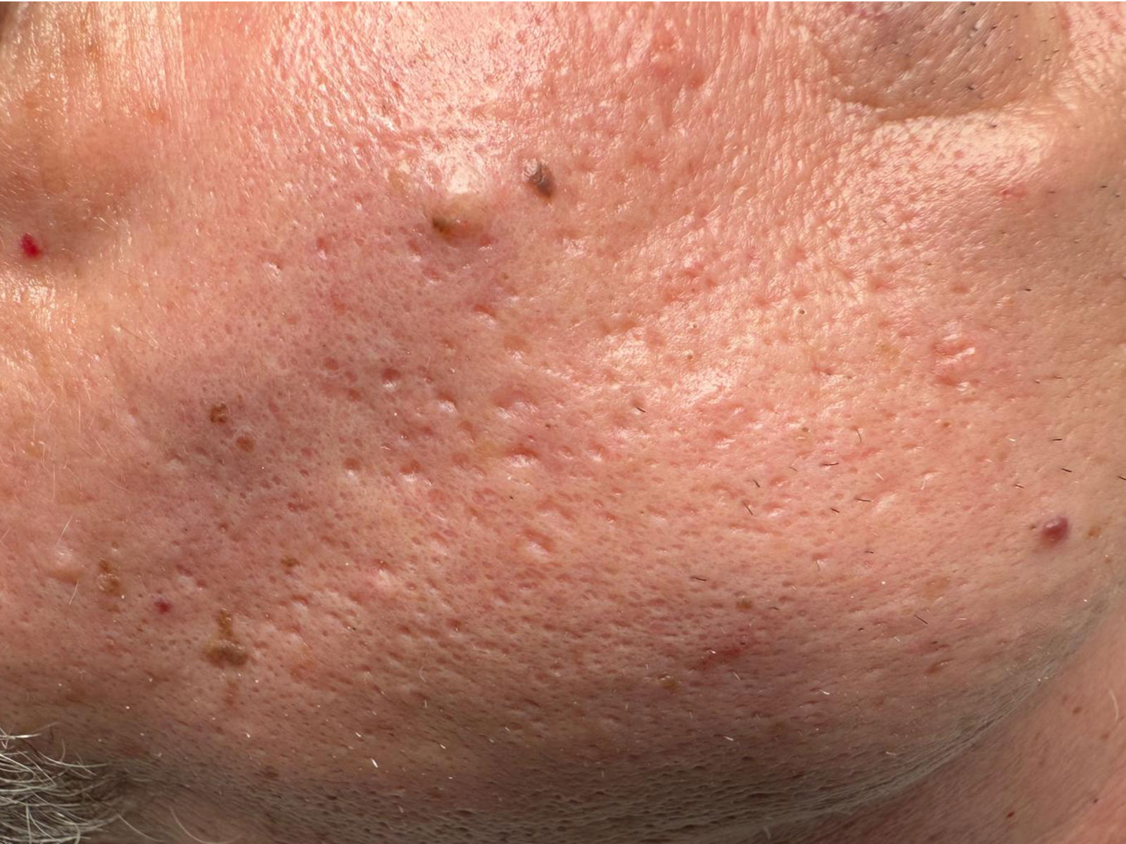 Nahaufnahme der Gesichtshaut nach einer Microdermabrasion