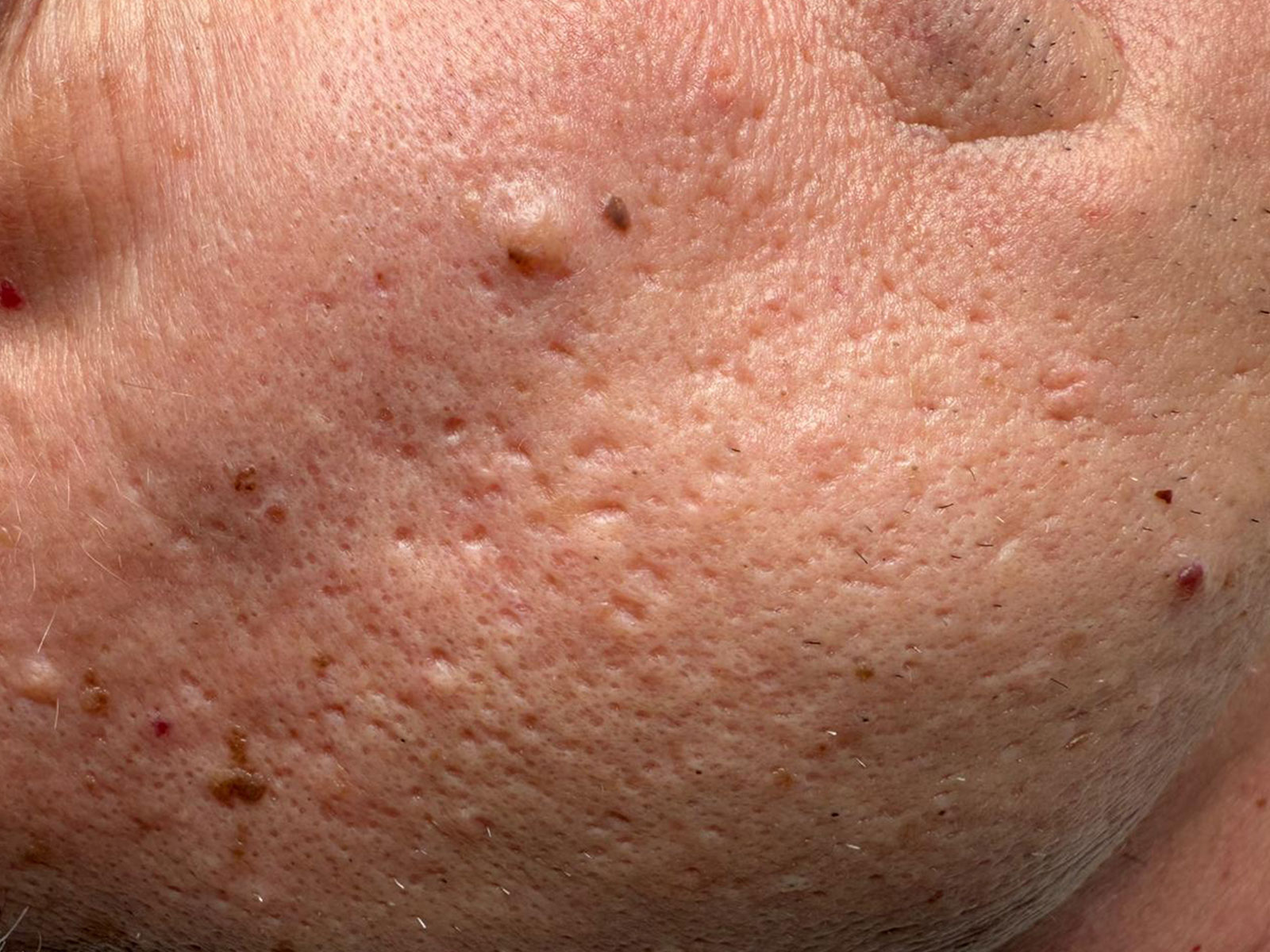 Nahaufnahme des Hautbildes vor einer Mikrodermabrasion